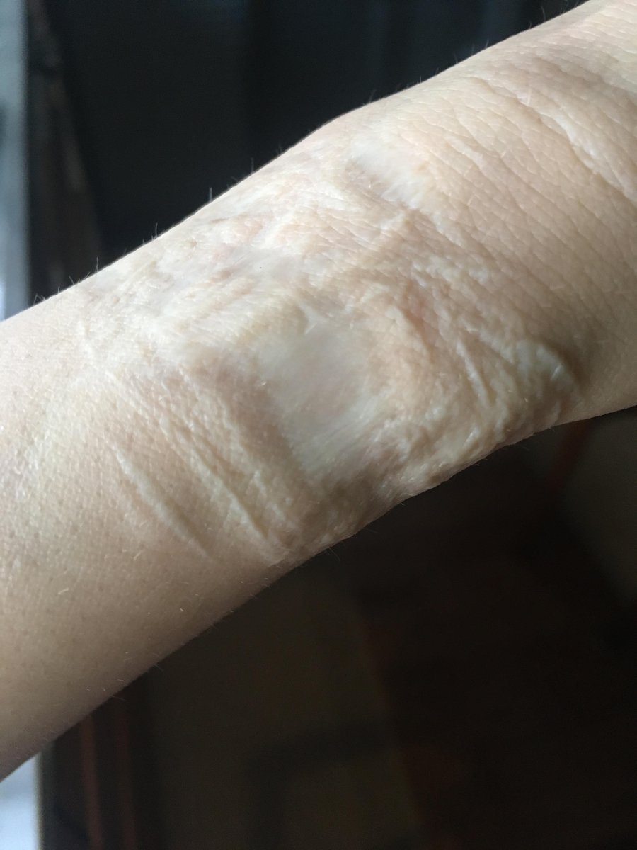 Photo of the tattoo titled Transforming Scars into Art