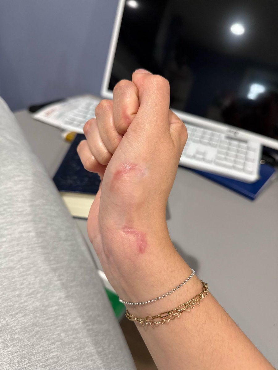 Photo of the tattoo titled Covering a Scar - Seeking Ideas